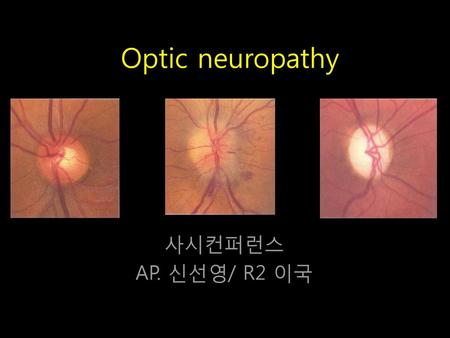 Optic neuropathy 사시컨퍼런스 AP. 신선영/ R2 이국
