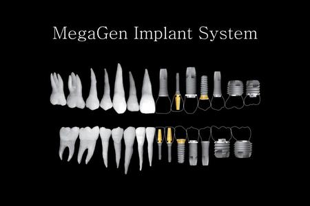 MegaGen Implant System