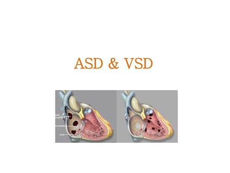 ASD & VSD.
