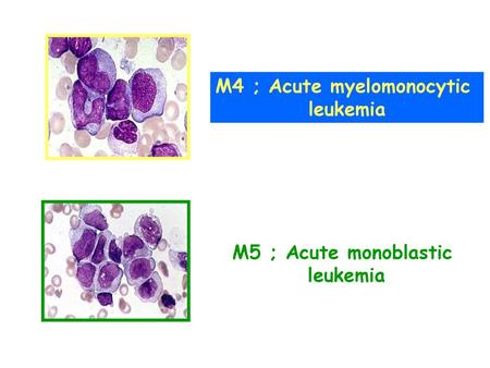 M4 ; Acute myelomonocytic