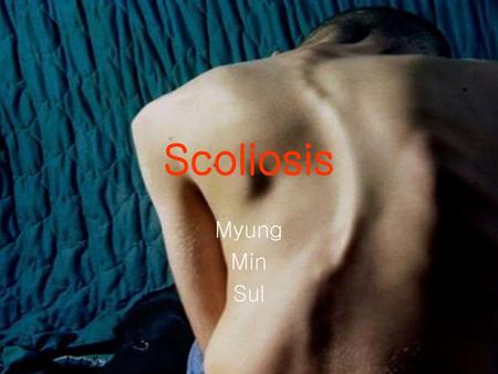 Scoliosis Myung Min Sul.