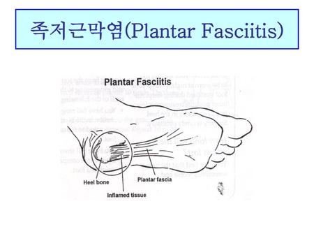 족저근막염(Plantar Fasciitis)