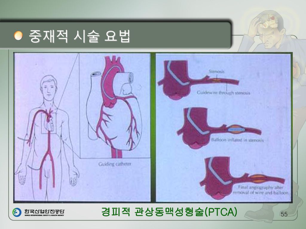 중재적 시술 요법 경피적 관상동맥성형술(PTCA)