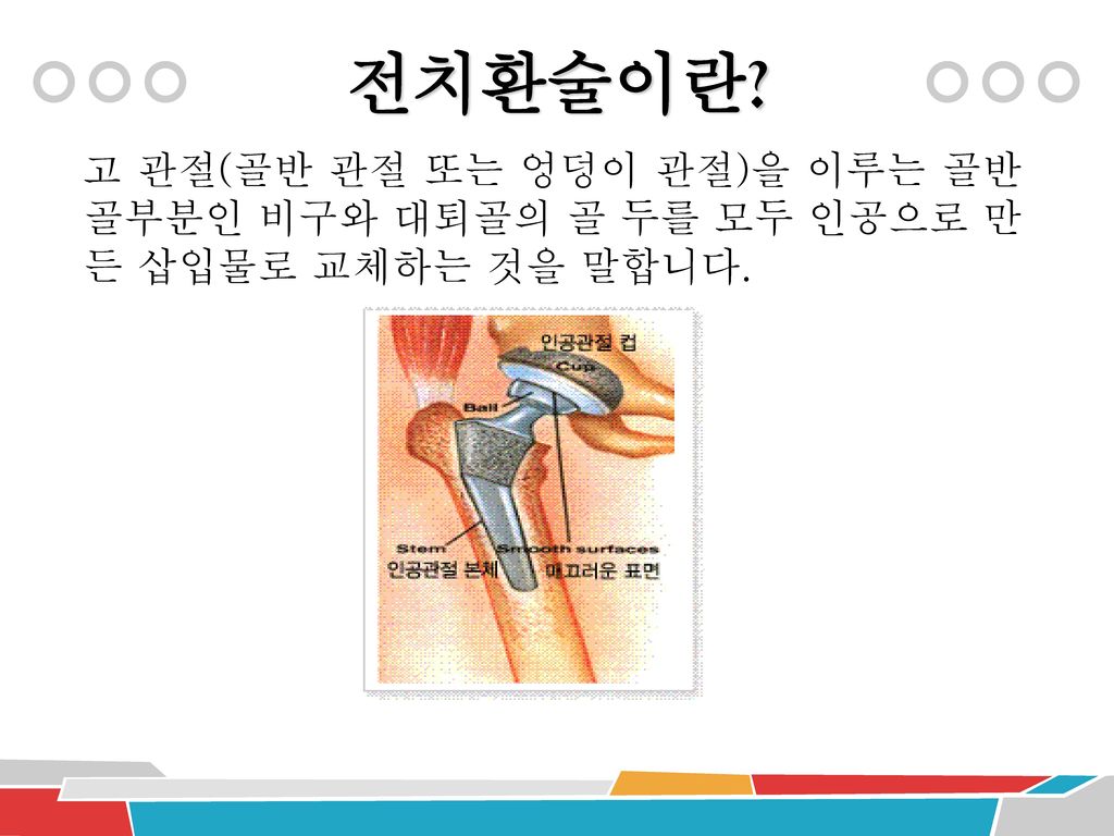 전치환술이란 고 관절(골반 관절 또는 엉덩이 관절)을 이루는 골반 골부분인 비구와 대퇴골의 골 두를 모두 인공으로 만든 삽입물로 교체하는 것을 말합니다.