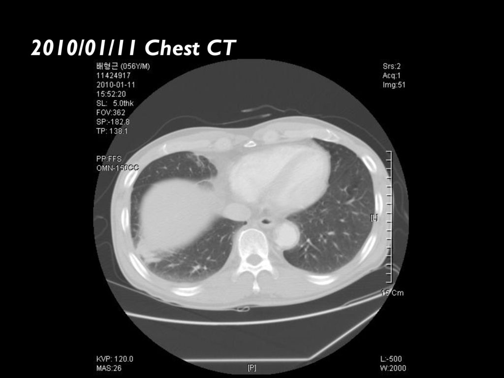 2010/01/11 Chest CT Cavitary mass, RLL. -possible actinomycosis.