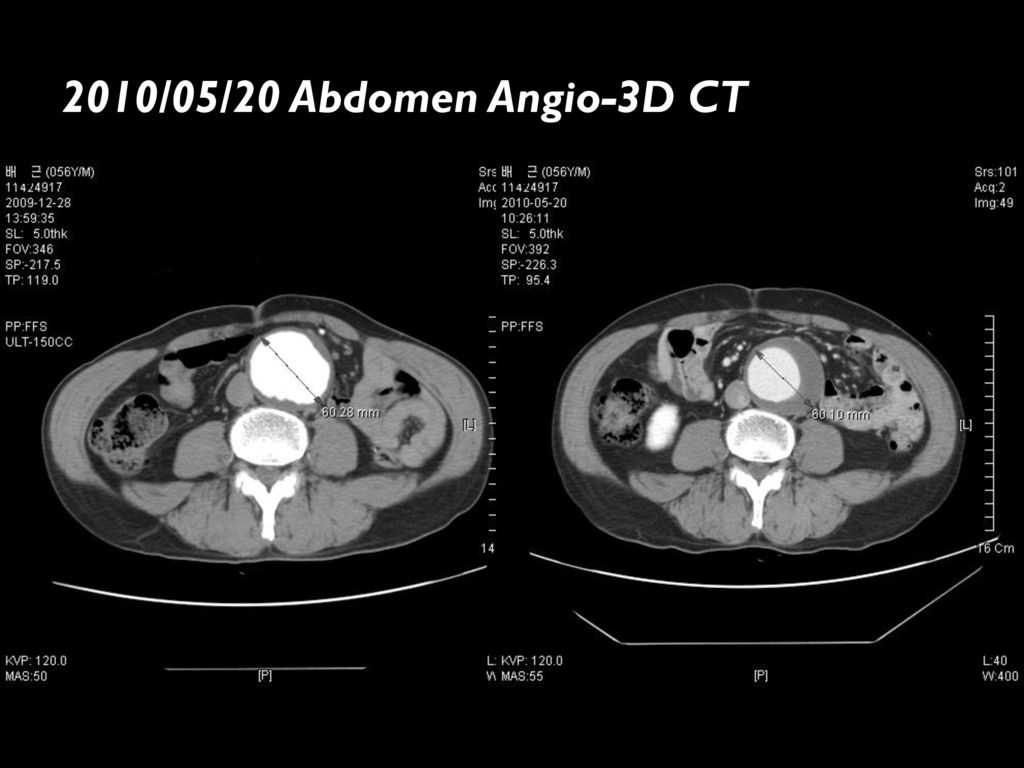 2010/05/20 Abdomen Angio-3D CT