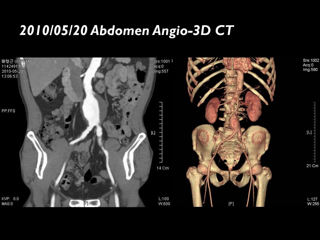2010/05/20 Abdomen Angio-3D CT