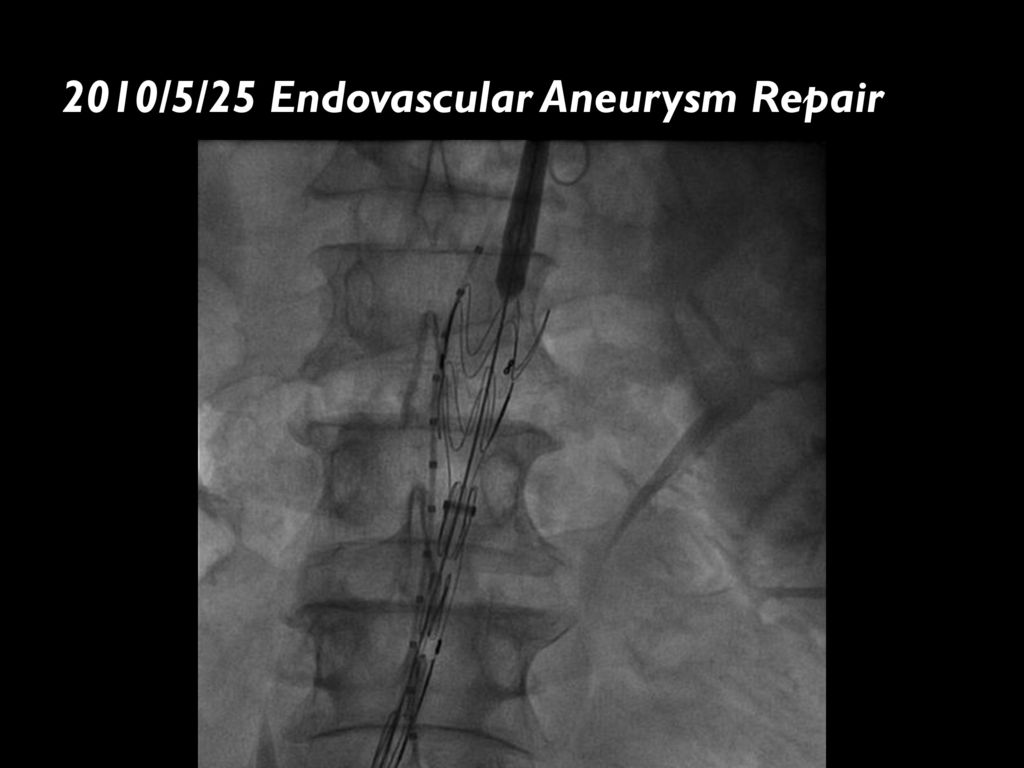 2010/5/25 Endovascular Aneurysm Repair