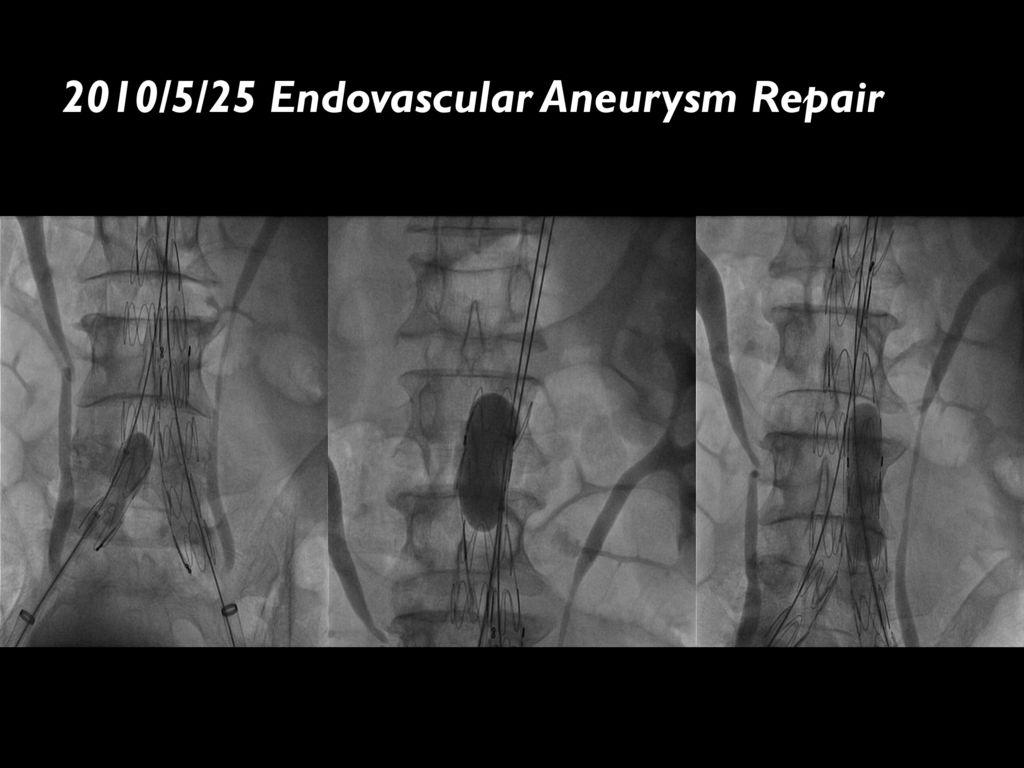 2010/5/25 Endovascular Aneurysm Repair