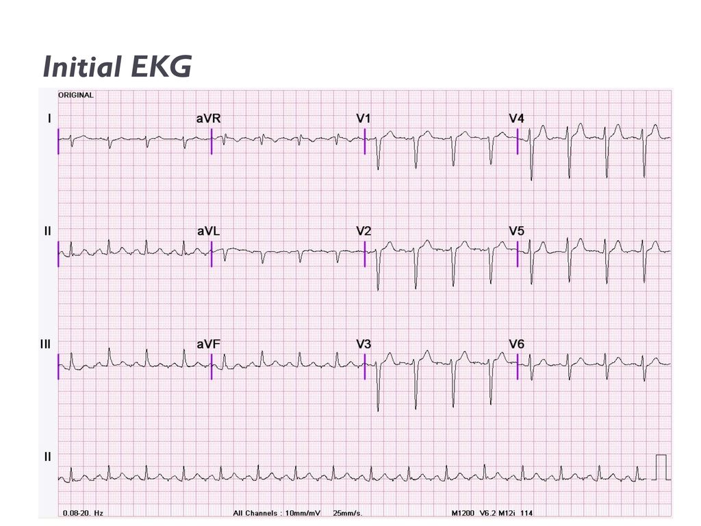 Initial EKG Minor RAD