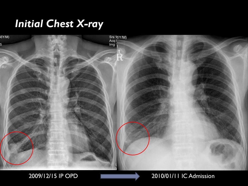 Initial Chest X-ray 2009/12/15 IP OPD 2010/01/11 IC Admission