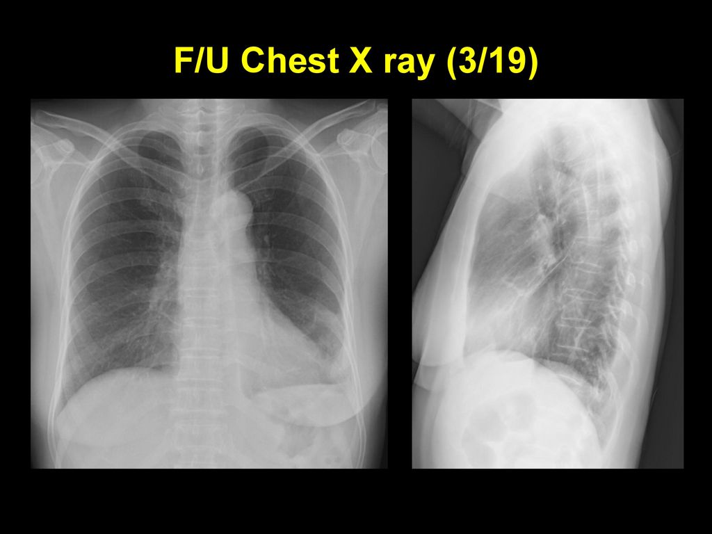 F/U Chest X ray (3/19)