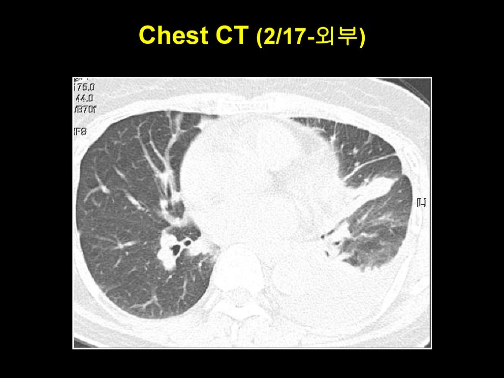 Chest CT (2/17-외부)