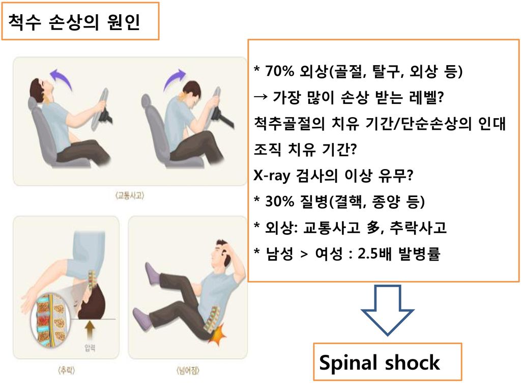 Spinal shock 척수 손상의 원인 * 70% 외상(골절, 탈구, 외상 등) → 가장 많이 손상 받는 레벨
