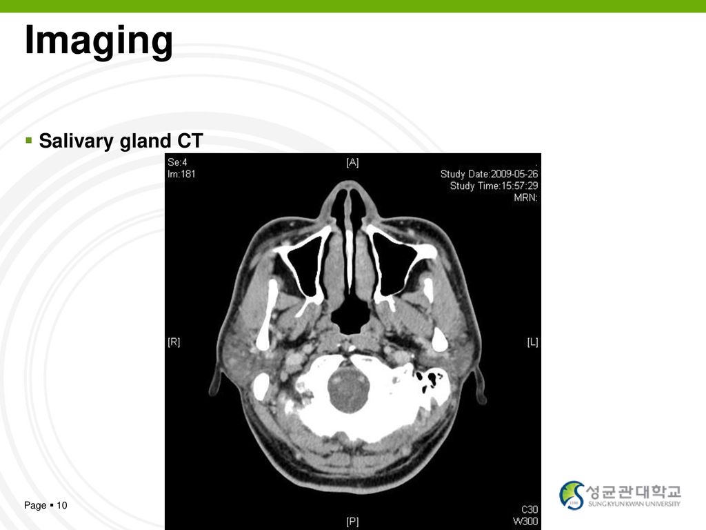 Imaging Salivary gland CT Page  10