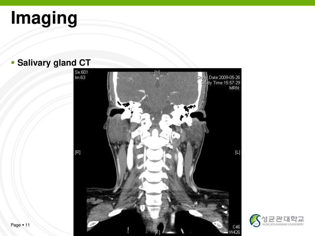 Imaging Salivary gland CT Page  11