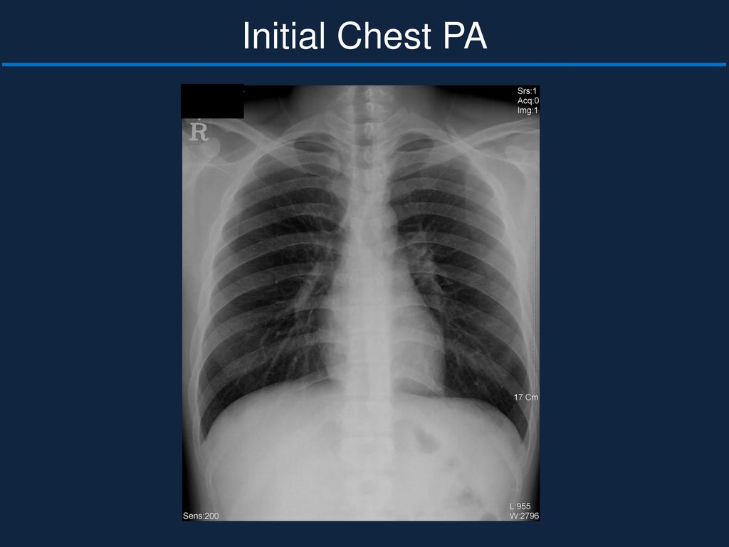 Initial Chest PA Bony thorax intact Cardiomegaly : none