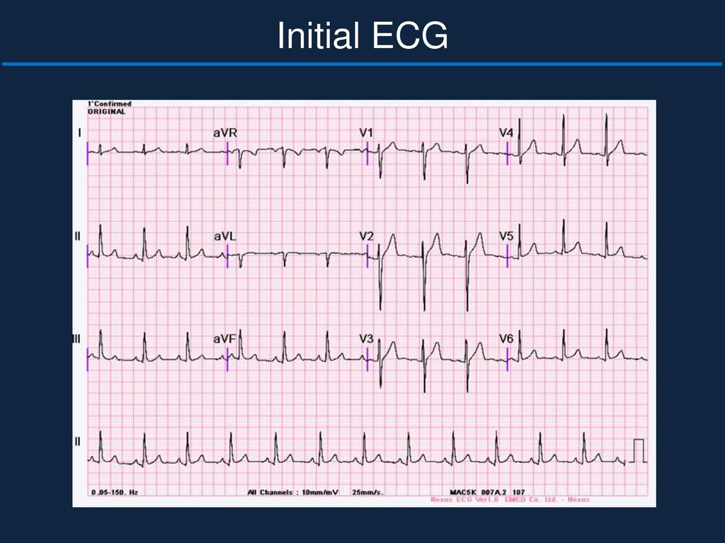 Initial ECG Normal sinus rhythm Rate : 90회 가량 Axis : normal