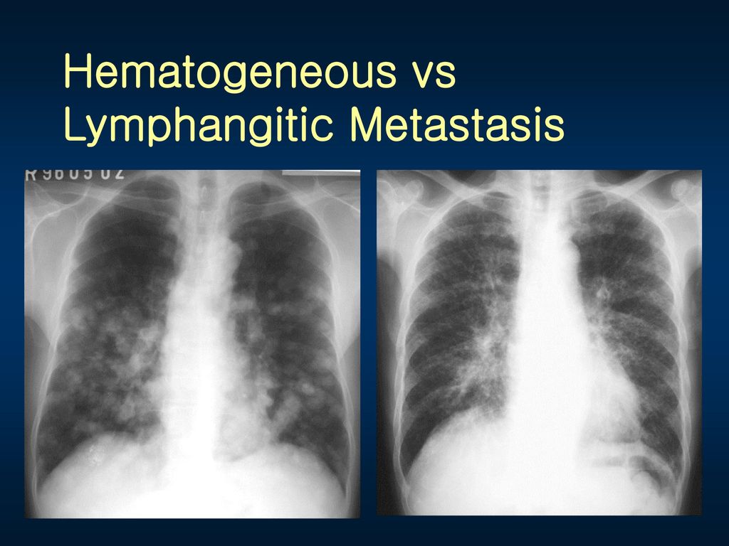 Hematogeneous vs Lymphangitic Metastasis
