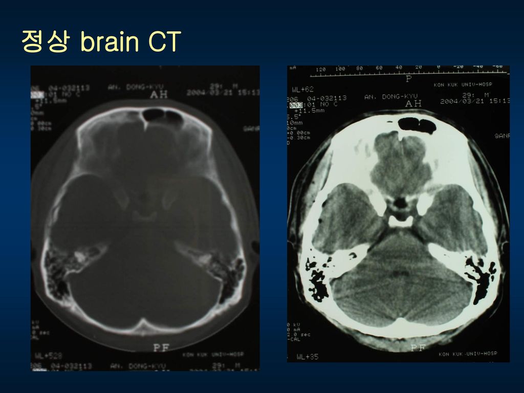 정상 brain CT