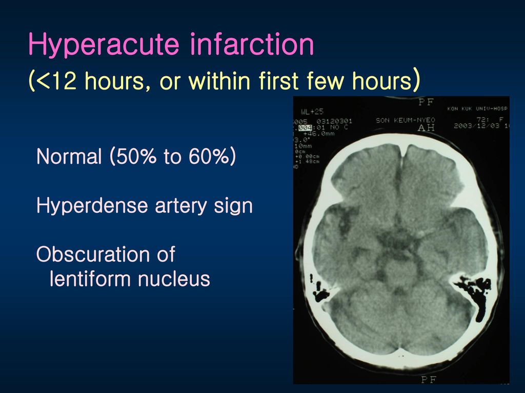 Hyperacute infarction (<12 hours, or within first few hours)