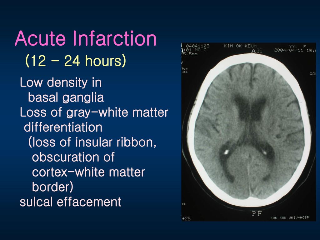 Acute Infarction ( hours) Low density in basal ganglia