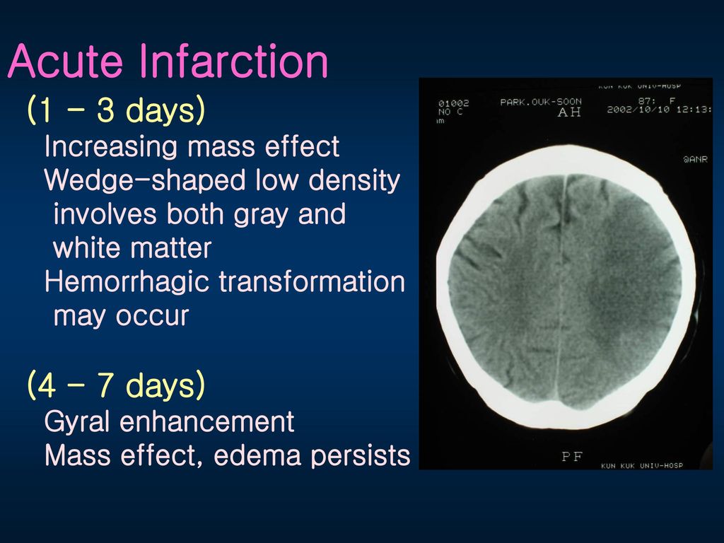 Acute Infarction (1 - 3 days) (4 - 7 days) Increasing mass effect