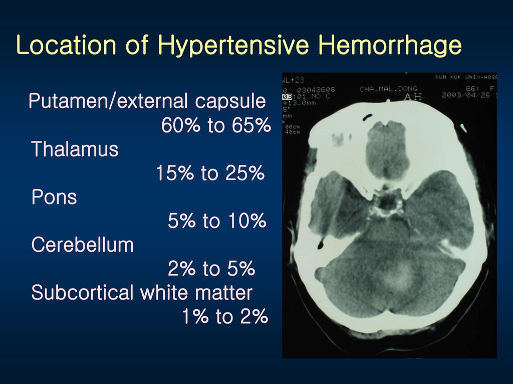 Location of Hypertensive Hemorrhage