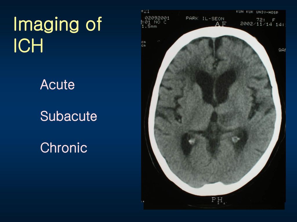 Imaging of ICH Acute Subacute Chronic