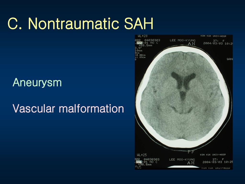C. Nontraumatic SAH Aneurysm Vascular malformation