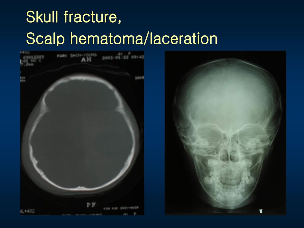 Skull fracture, Scalp hematoma/laceration