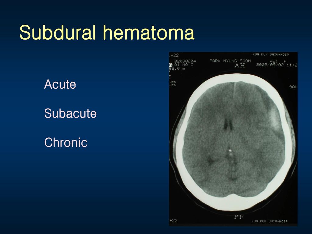 Subdural hematoma Acute Subacute Chronic