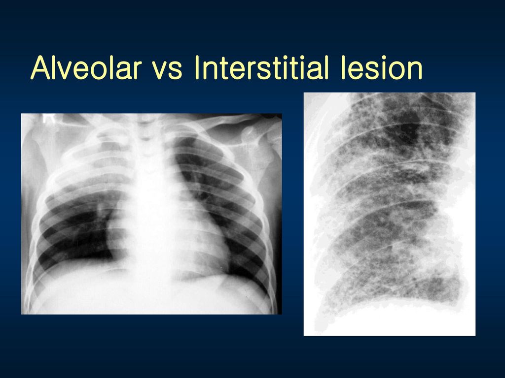 Alveolar vs Interstitial lesion