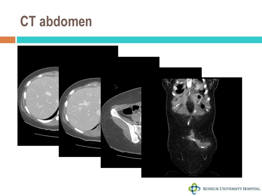 CT abdomen
