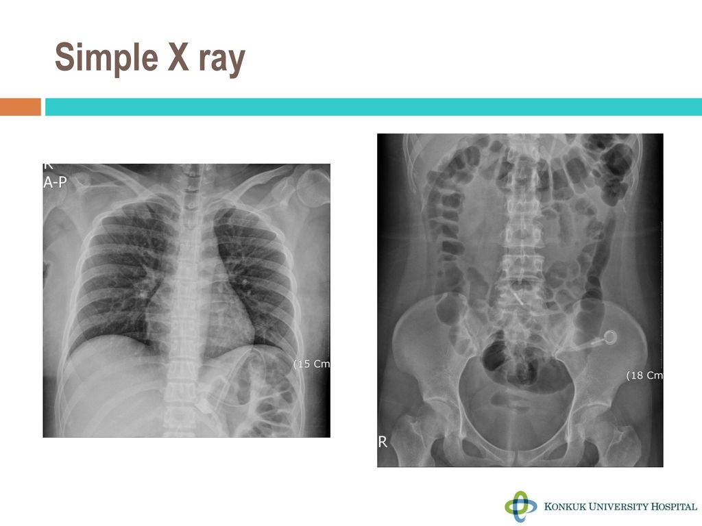 Simple X ray