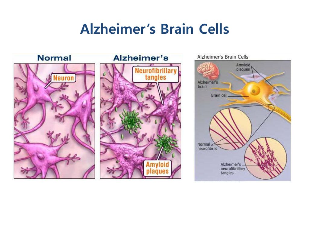 Alzheimer’s Brain Cells