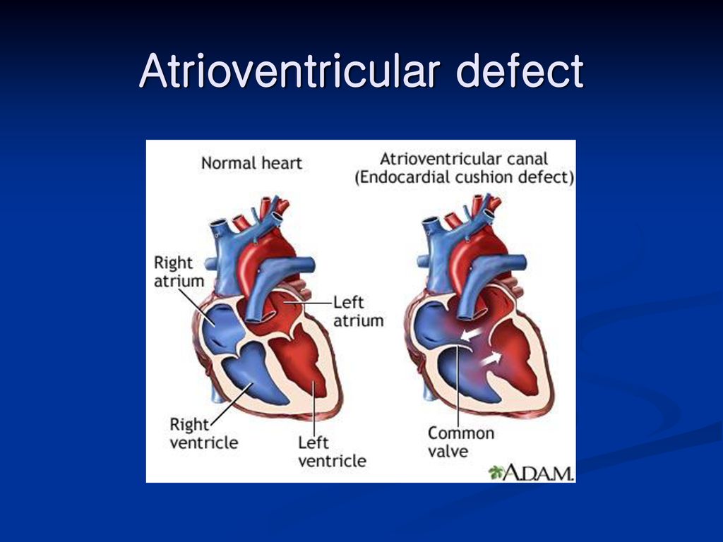 Atrioventricular defect