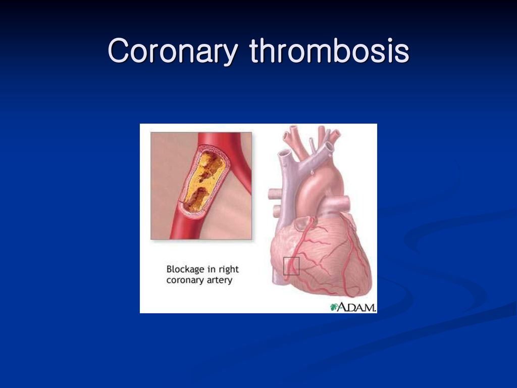 Coronary thrombosis