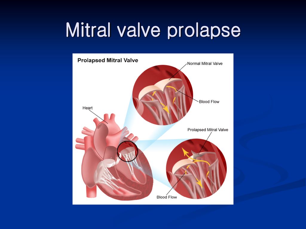 Mitral valve prolapse