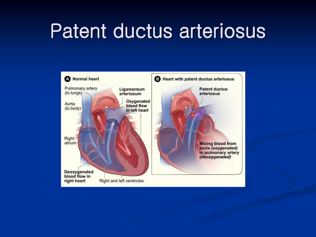 Patent ductus arteriosus