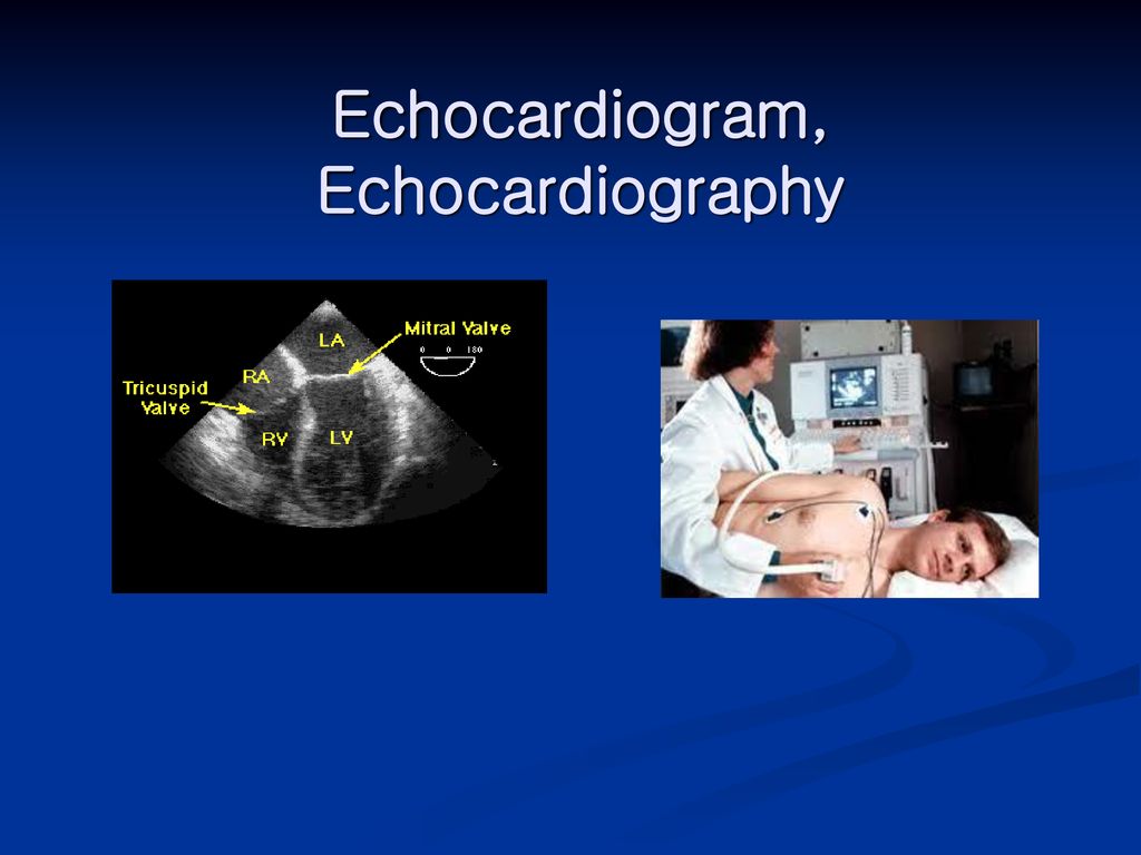 Echocardiogram, Echocardiography