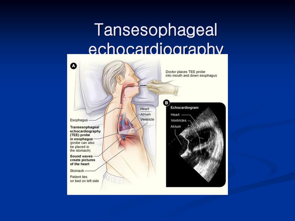 Tansesophageal echocardiography