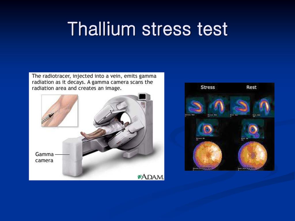 Thallium stress test