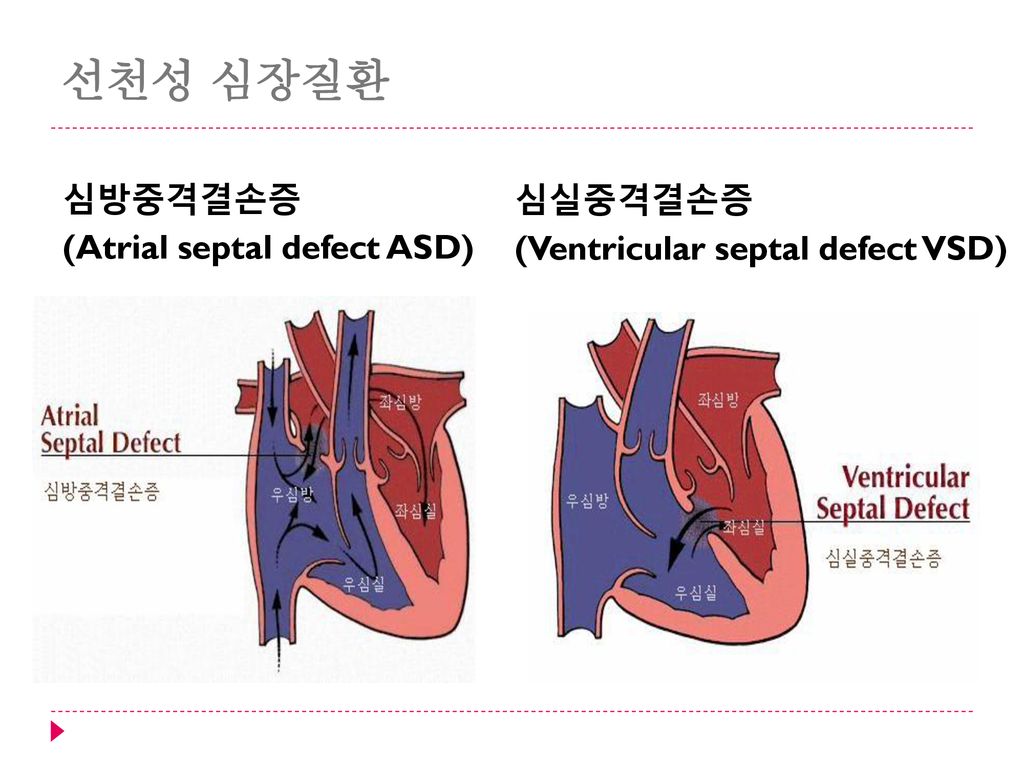 선천성 심장질환 심방중격결손증 (Atrial septal defect ASD) 심실중격결손증