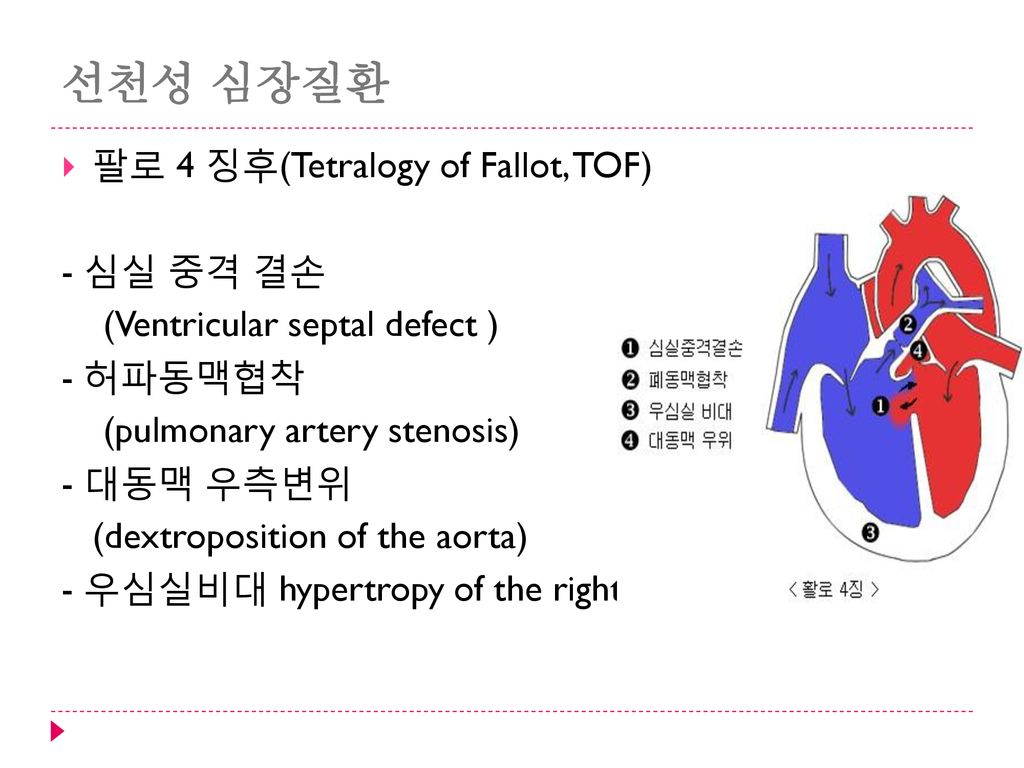 선천성 심장질환 팔로 4 징후(Tetralogy of Fallot, TOF) - 심실 중격 결손