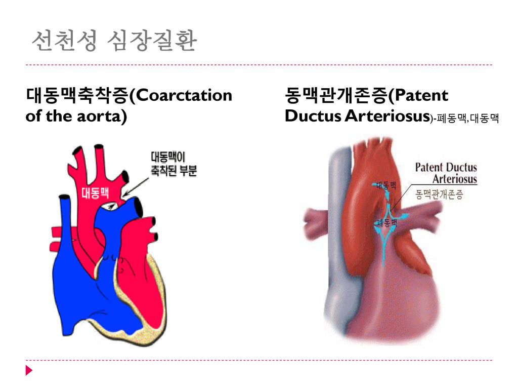 선천성 심장질환 대동맥축착증(Coarctation of the aorta)