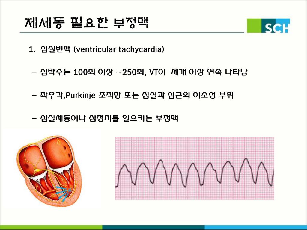제세동 필요한 부정맥) 심실빈맥 (ventricular tachycardia)