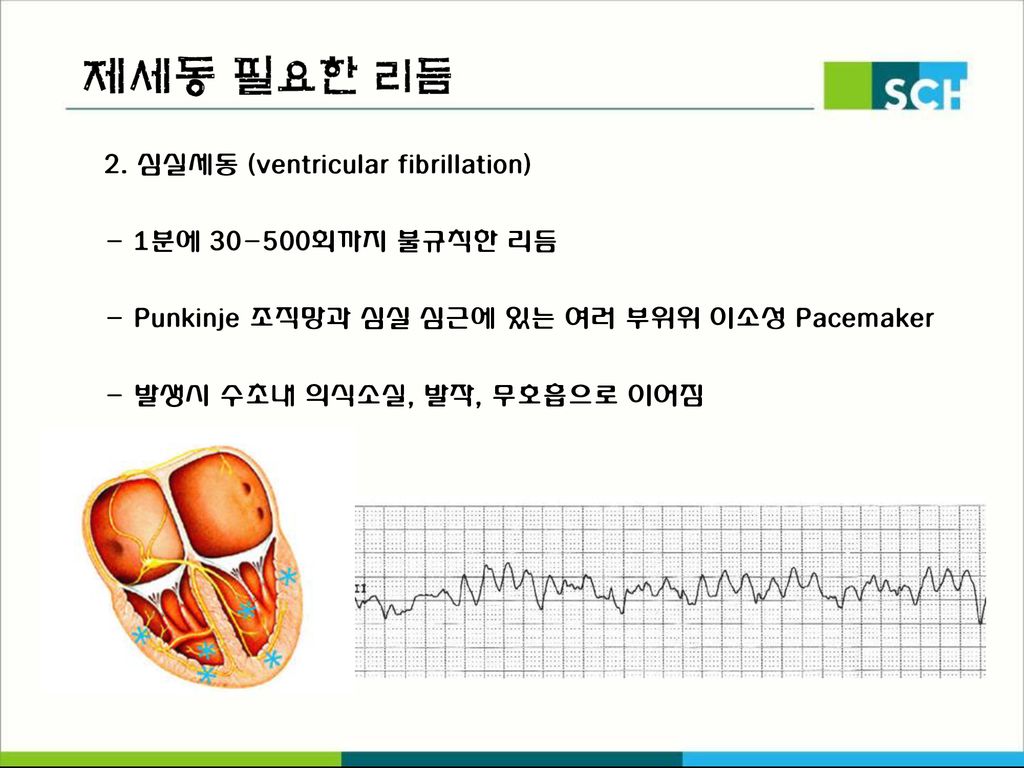 제세동 필요한 리듬) 2. 심실세동 (ventricular fibrillation) - 1분에 회까지 불규칙한 리듬
