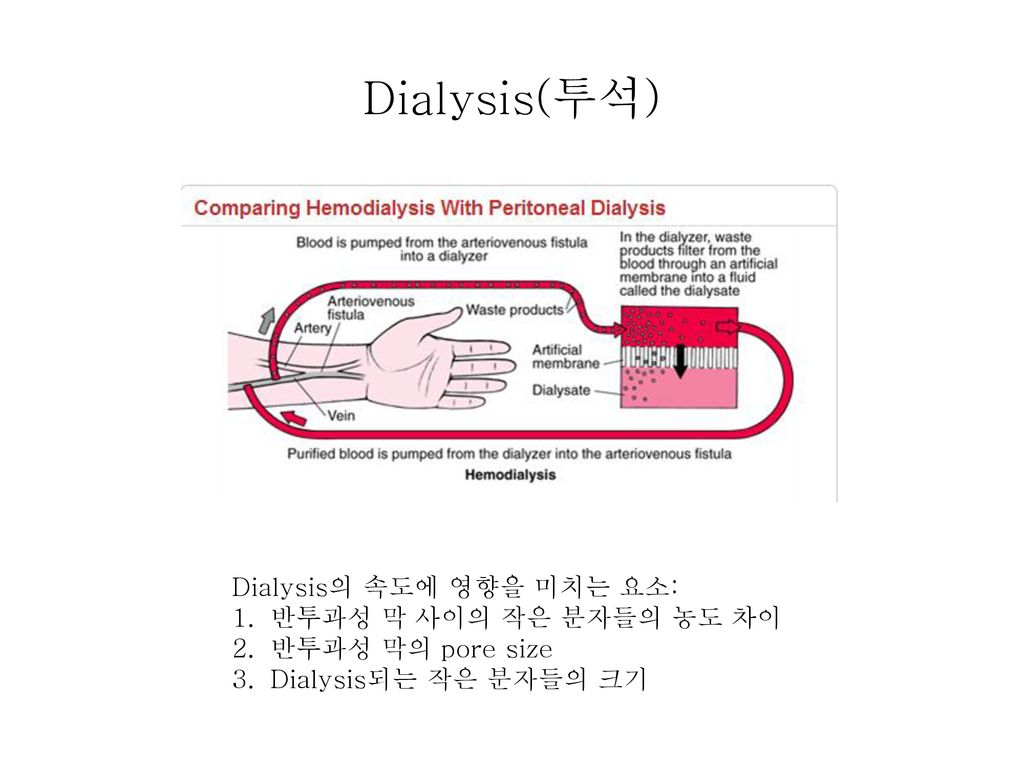 Dialysis(투석) Dialysis의 속도에 영향을 미치는 요소: 반투과성 막 사이의 작은 분자들의 농도 차이